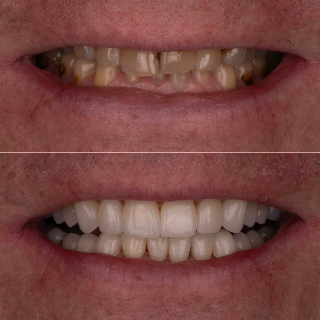 Before and after full mouth rehabilitation transformation